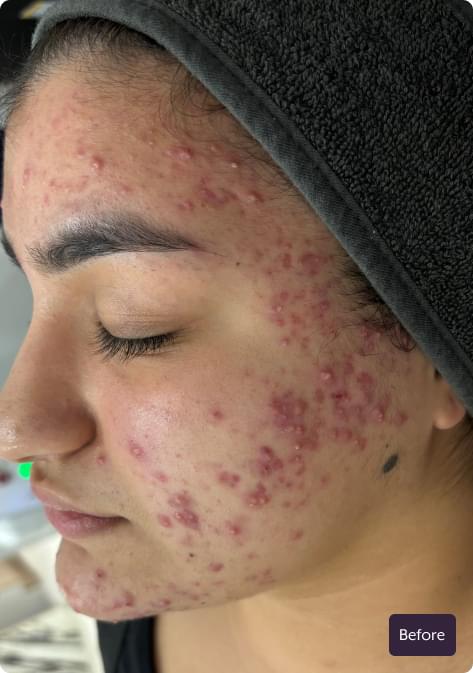 Client skin before SDL Australia acne treatment
