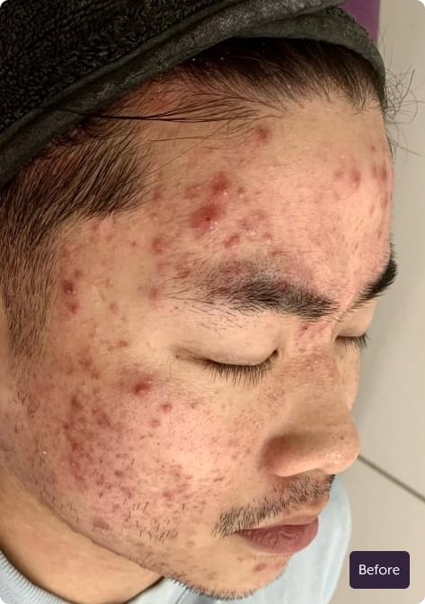 Client skin before SDL Australia laser skin treatment