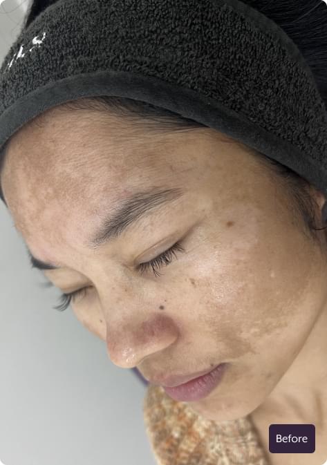 Client skin before SDL Australia anti-ageing treatment